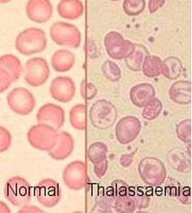 Obat Herbal Thalasemia